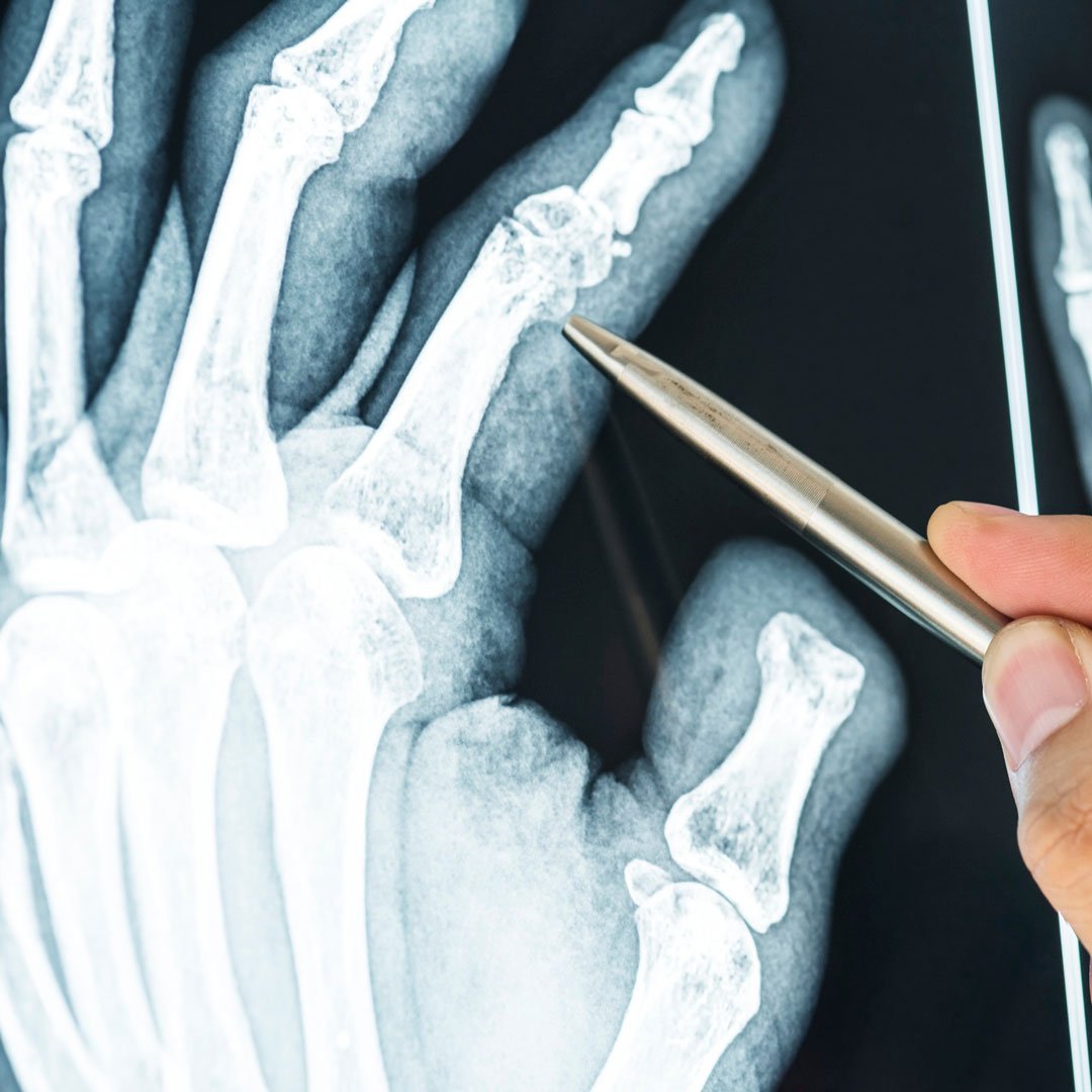 RX Mano Fracturada RX Mano Fracturada